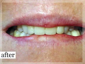 After Image: Smile Makeover - front