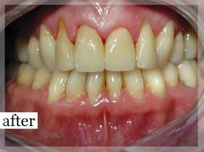 After Image: Smile Makeover - front