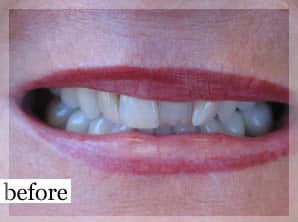 Before Image: Smile Makeover - front