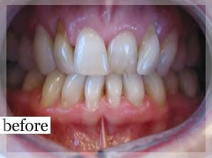 Before Image: Smile Makeover - front