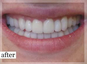 After Image: Smile Makeover - front