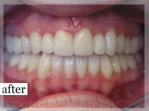 After Image: Smile Makeover - front