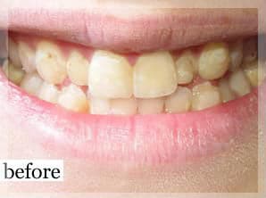 Before Image: Smile Makeover - front