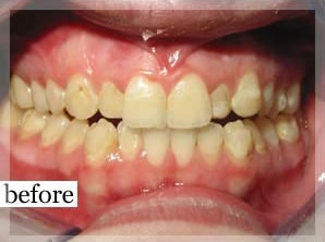 Before Image: Smile Makeover - front