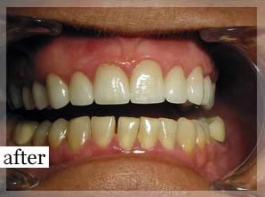 After Image: Smile Makeover - front