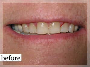 Before Image: Smile Makeover - front