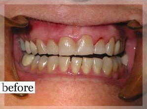 Before Image: Smile Makeover - front