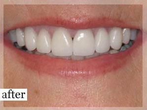 After Image: Smile Makeover - front