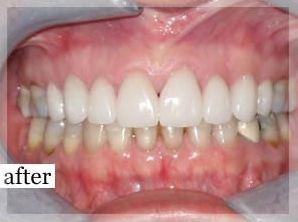 After Image: Smile Makeover - front