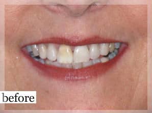 Before Image: Smile Makeover - front