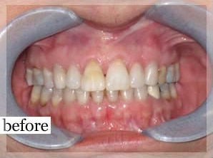 Before Image: Smile Makeover - front