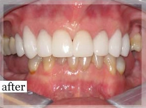 After Image: Smile Makeover - front