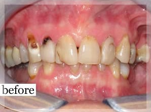 Before Image: Smile Makeover - front