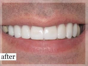 After Image: Smile Makeover - front