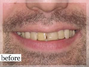 Before Image: Smile Makeover - front