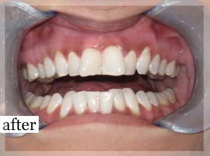 After Image: Smile Makeover - front