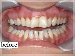 Before Image: Smile Makeover - front