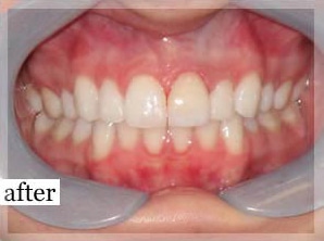 After Image: Smile Makeover - front