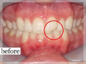 Before Image: Smile Makeover - front