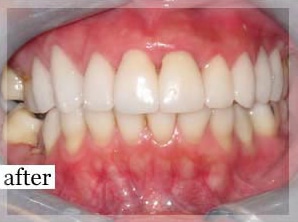 After Image: Smile Makeover - front