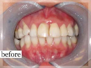 Before Image: Smile Makeover - front