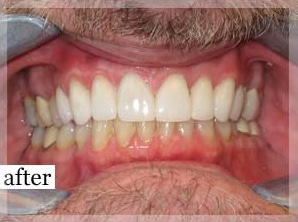 After Image: Smile Makeover - front