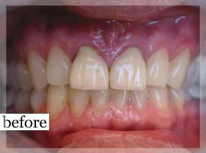 Before Image: Smile Makeover - front