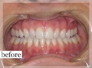 Before Image: Smile Makeover - front