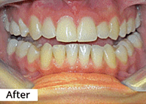 After Image: Smile Makeover - front