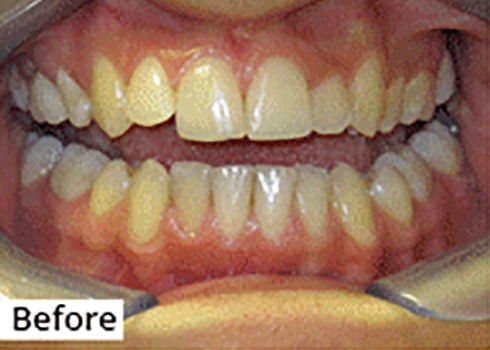 Before Image: Smile Makeover - front