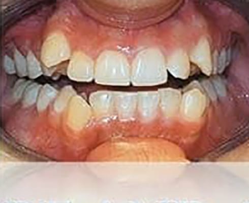 Before Image: Smile Makeover - front