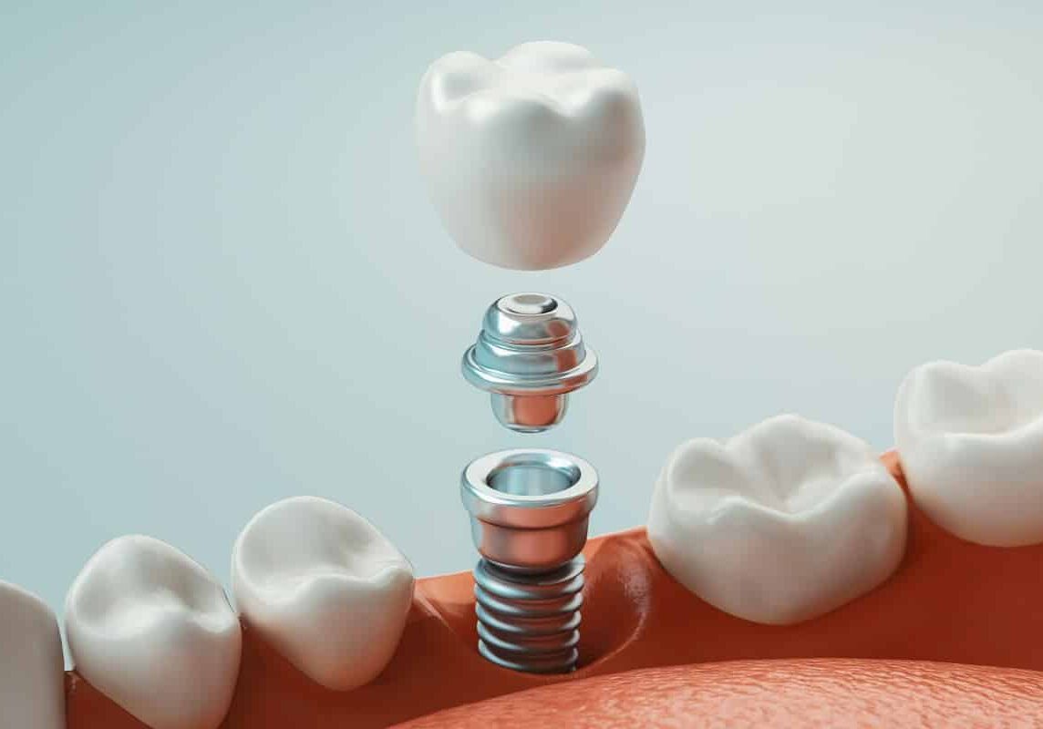 Dental care, dental implant, 3d rendering Dental care, dental implant, 3d rendering